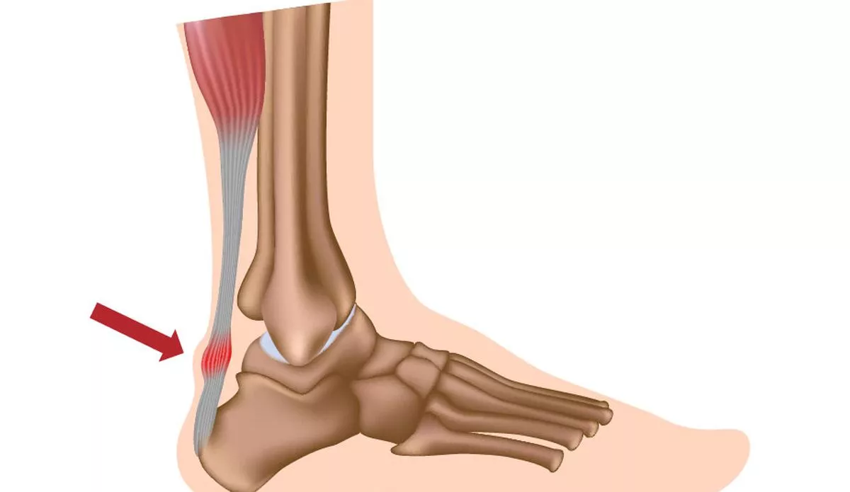 Aşil nedir? Aşil tendonu nerede bulunur, aşil tendonu kopması tedavisi?